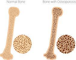 Raloxifene for osteoporosis